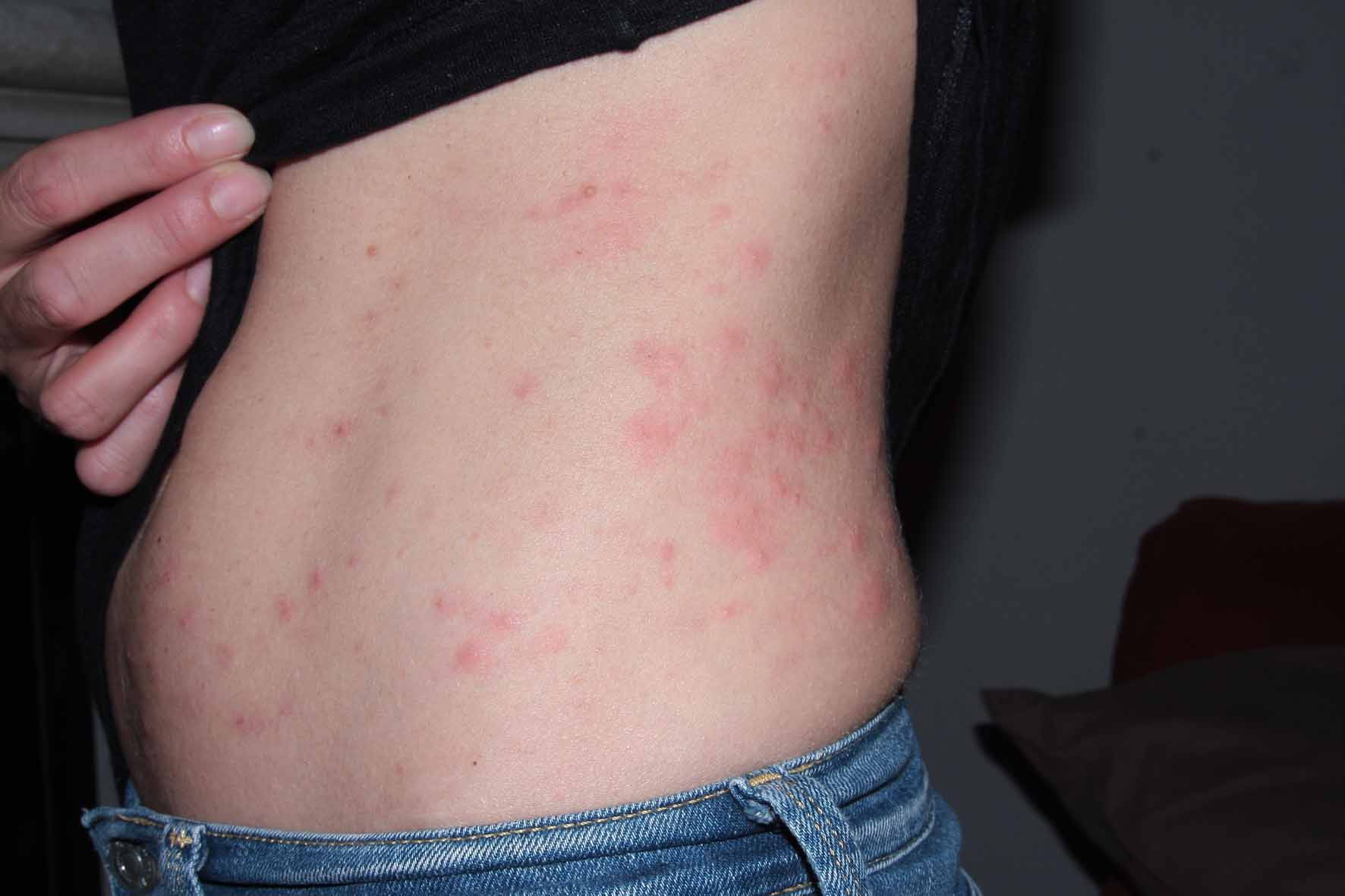   Piqure multiples sous les vêtements
